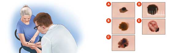 ABCDE test - melanoom