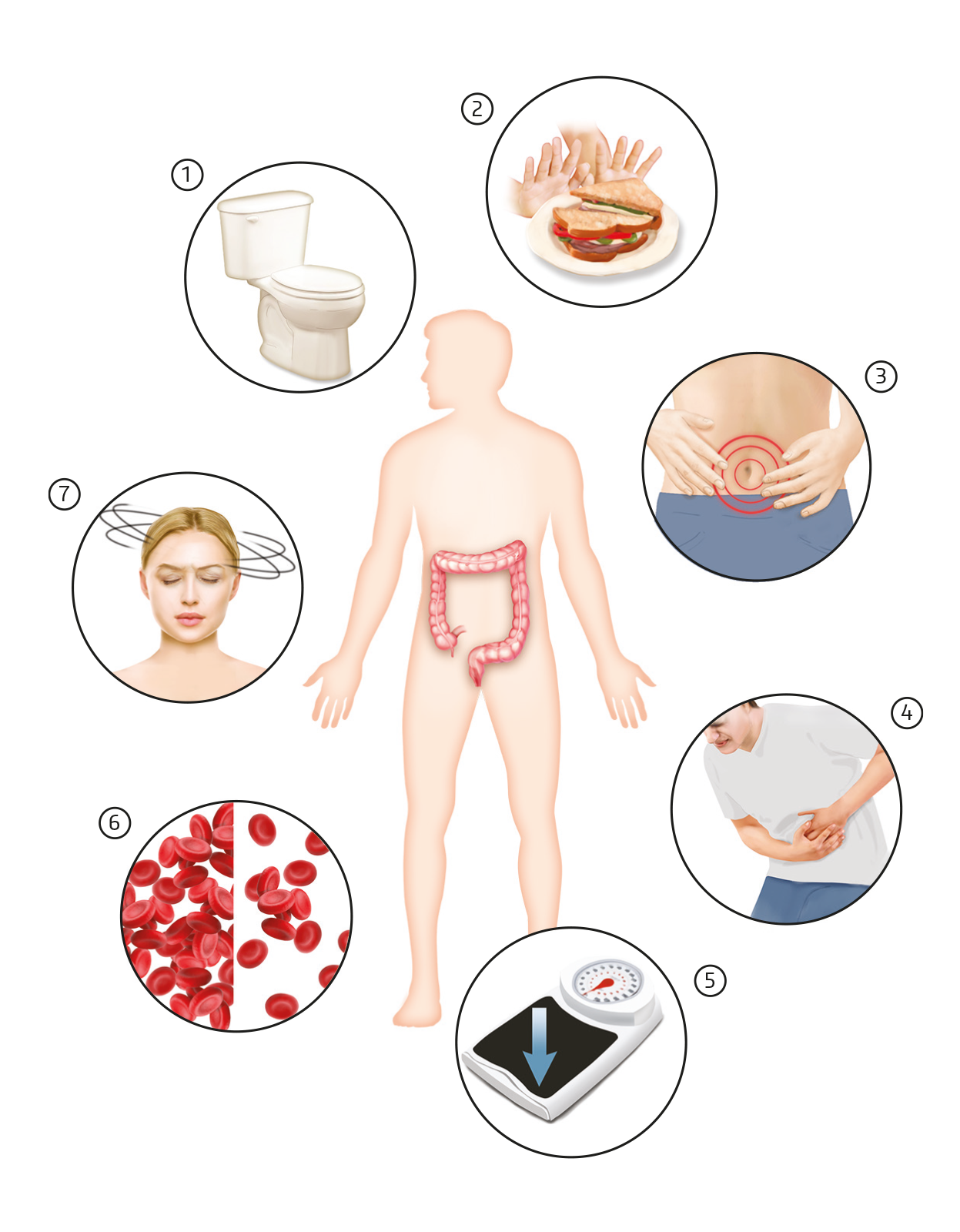 Symptomen Darmkanker